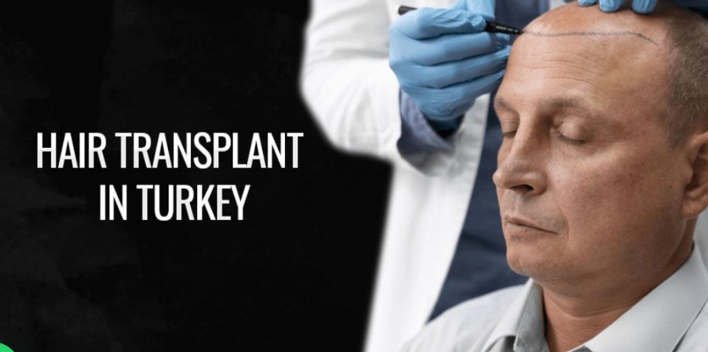Nejlepší transplantace vlasů v Istanbulu